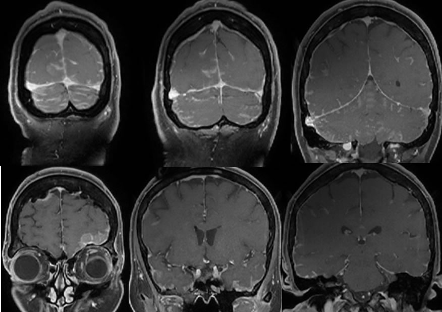 What Is The Progression Of Leptomeningeal Disease